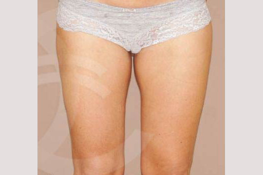 Liposuction HIPS INNER AND OUTER THIGHS ante/post-op I
