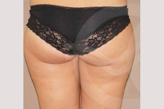 Liposuction HIPS INNER AND OUTER THIGHS ante/post-op II
