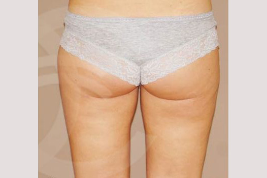 Liposuction HIPS INNER AND OUTER THIGHS ante/post-op II