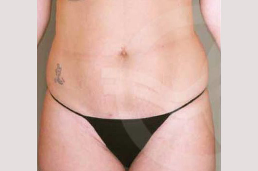 Liposuction ABDOMEN, WAIST AND LEGS ante/post-op I