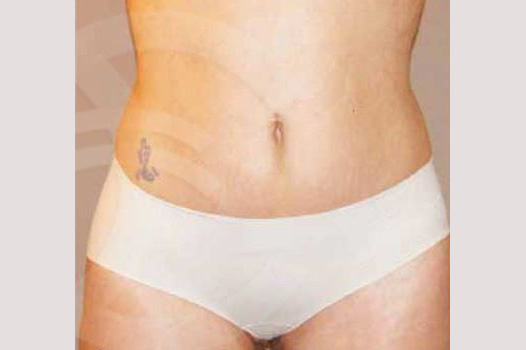 Photos Liposuction  ante/post-op I