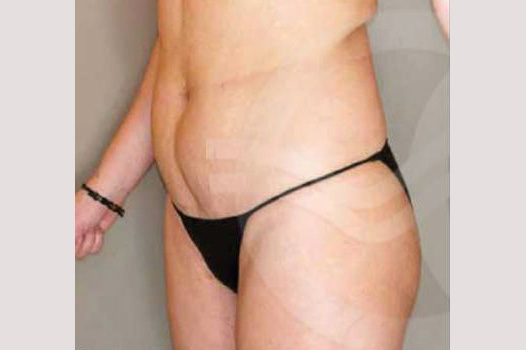 Liposuction ABDOMEN, WAIST AND LEGS ante/post-op II