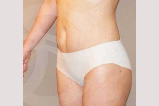 Liposuction ABDOMEN, WAIST AND LEGS ante/post-op II