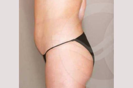 Liposuction ABDOMEN, WAIST AND LEGS ante/post-op III