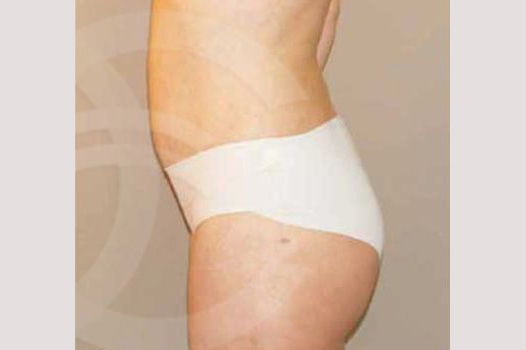 Liposuction ABDOMEN, WAIST AND LEGS ante/post-op III