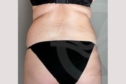 Liposuction BUTTOCKS ante/post-op I