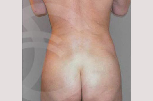 Liposuction BUTTOCKS ante/post-op I