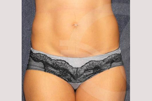 Photos Liposuction  ante/post-op I