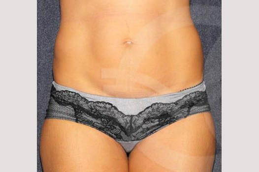 Liposuction FLANKS AND STOMACH AREA ante/post-op I