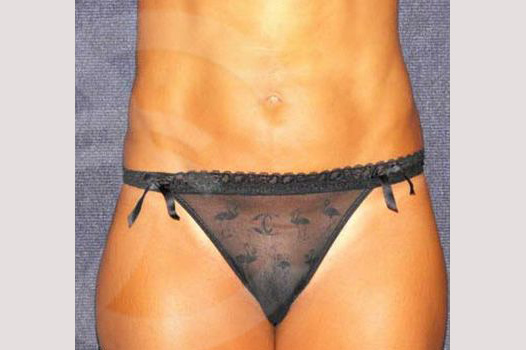 Photos Liposuction  ante/post-op I