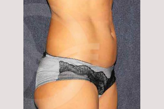 Liposuction FLANKS AND STOMACH AREA ante/post-op II