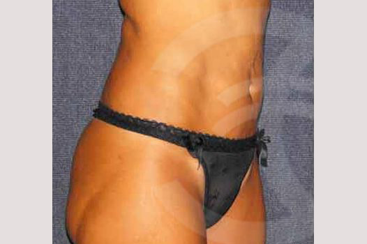 Liposuction FLANKS AND STOMACH AREA ante/post-op II