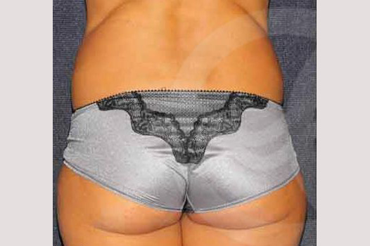 Photos Liposuction  ante/post-op III