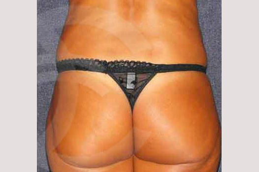 Photos Liposuction  ante/post-op III