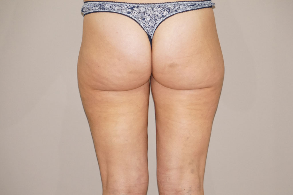 Liposuccion 1 post-op profil