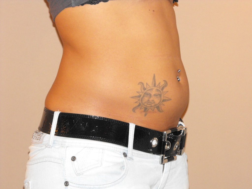 Photos Liposuction  ante/post-op II