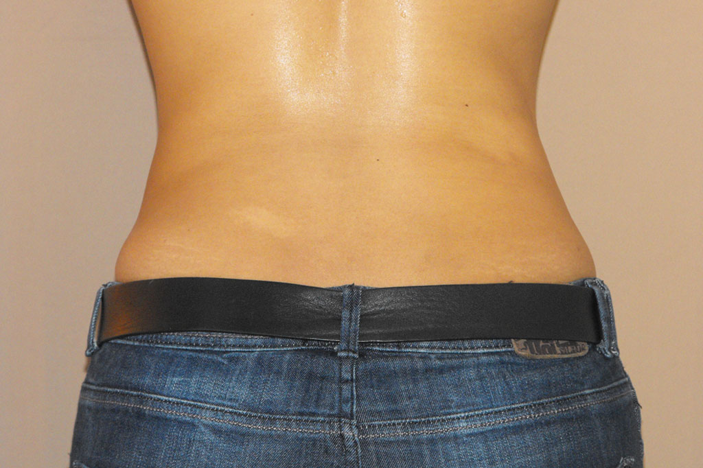 Liposuction Lipoplasty ante/post-op III