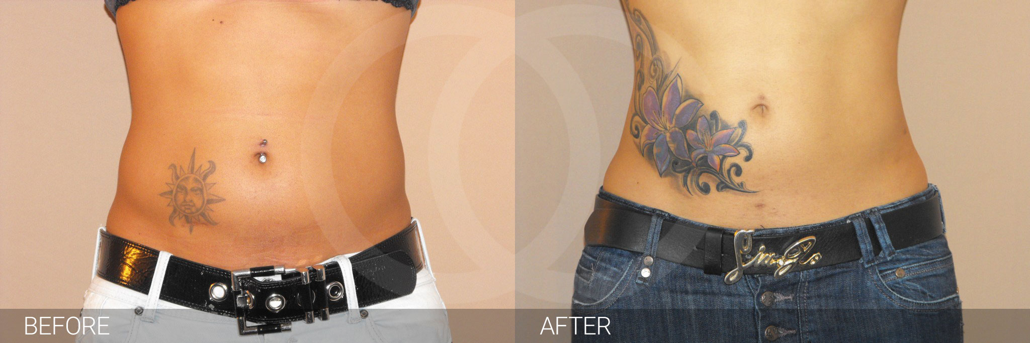 Antes y después Liposucción abdominal fotos reales de pacientes 2.1 | Ocean Clinic Marbella Madrid