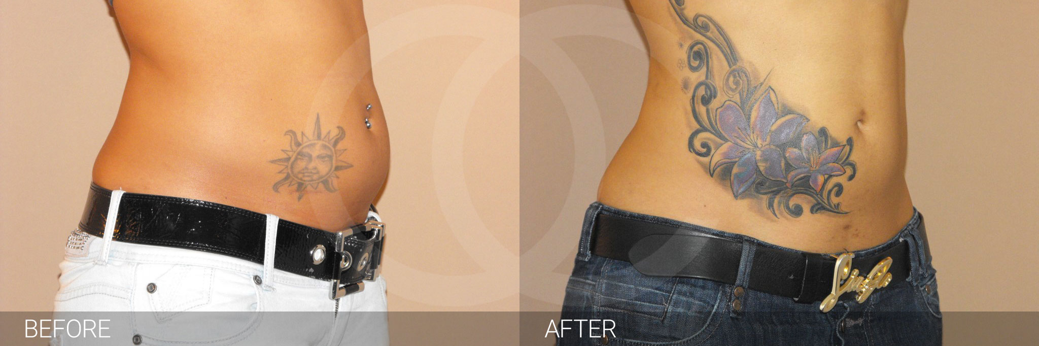 Antes y después Fotos de eliminar grasa abdominal fotos reales de pacientes 2.2 | Ocean Clinic Marbella Madrid
