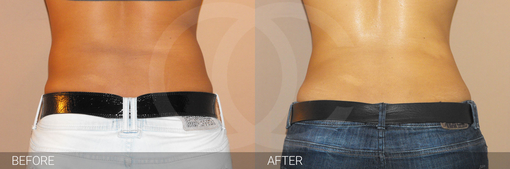 Antes y después Liposucción abdominal fotos reales de pacientes 2.3 | Ocean Clinic Marbella Madrid
