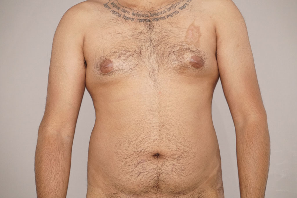 Liposuction Male surgery ante/post-op I