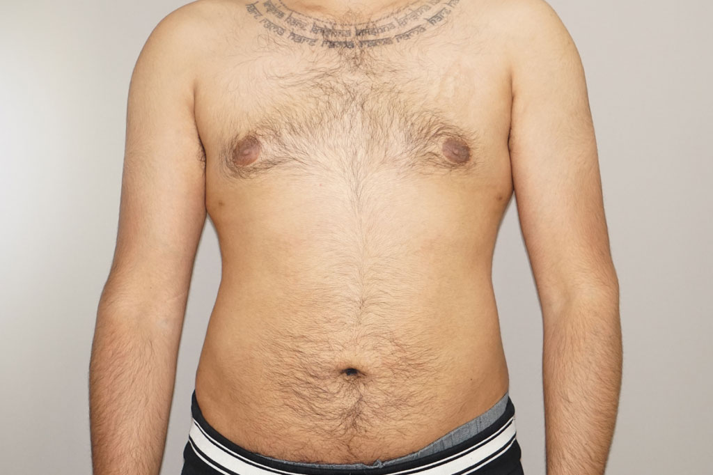Después Liposucción para hombres Foto caso clínico 3 vista frontal | Ocean Clinic Marbella Madrid