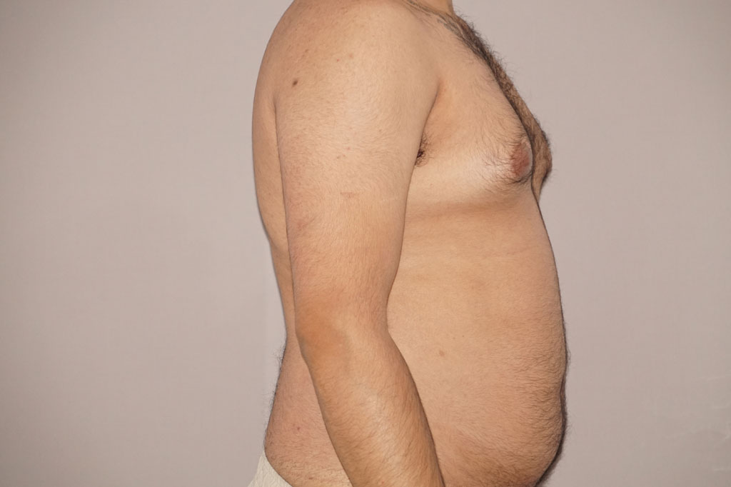 Antes Liposucción para hombres Foto caso clínico 3 vista lado | Ocean Clinic Marbella Madrid
