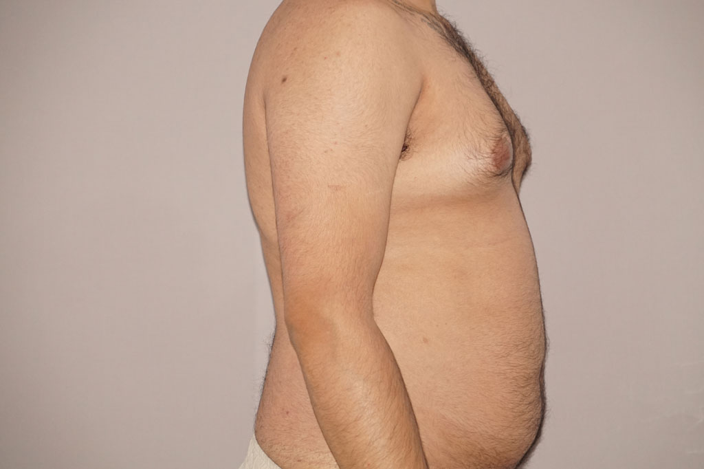 Liposuction Male surgery ante/post-op II