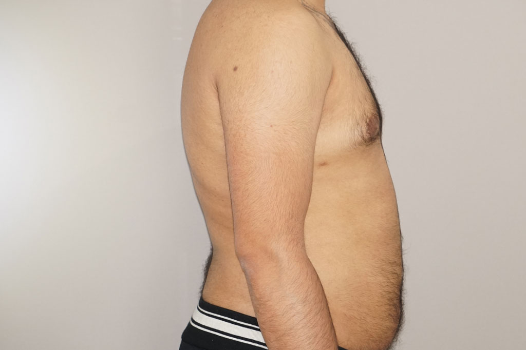 Liposuction Male surgery post-op lateral