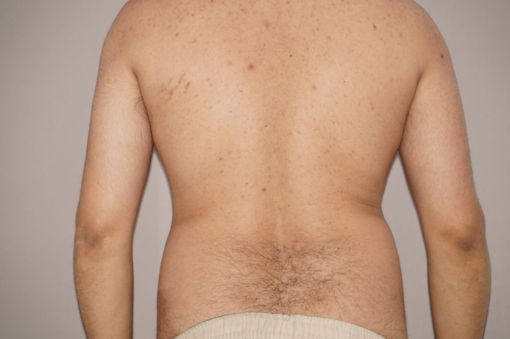Antes Liposucción para hombres Foto caso clínico 3 vista lateral | Ocean Clinic Marbella Madrid