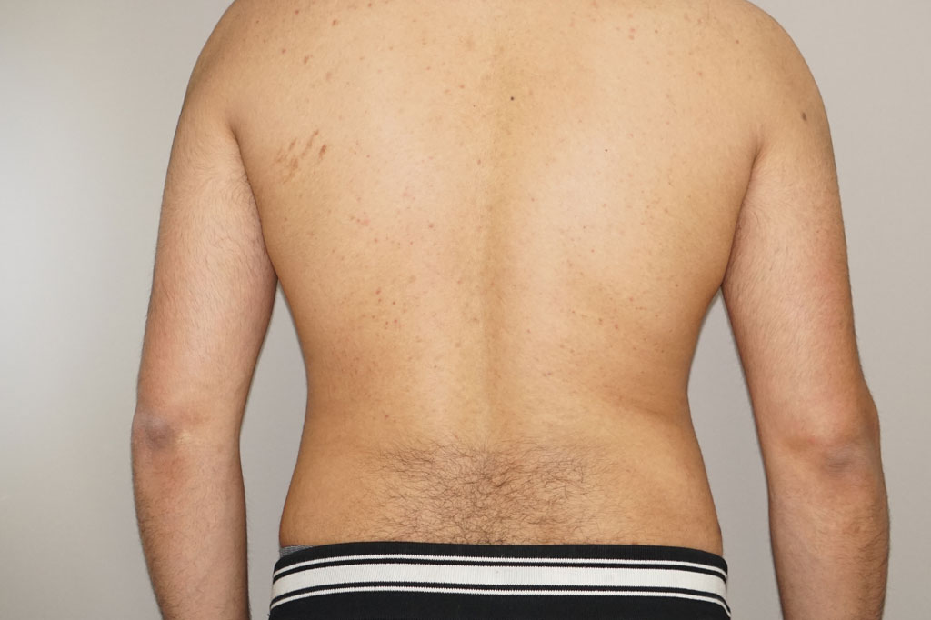 Después Liposucción para hombres Foto caso clínico 3 vista lateral | Ocean Clinic Marbella Madrid