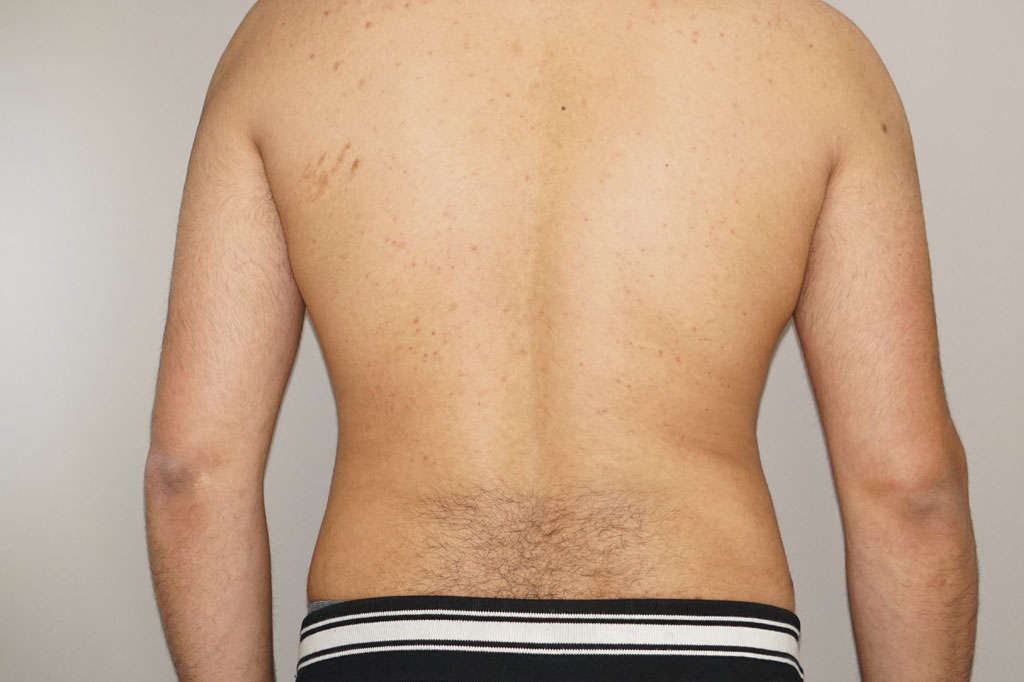 Liposuction Male surgery ante/post-op III