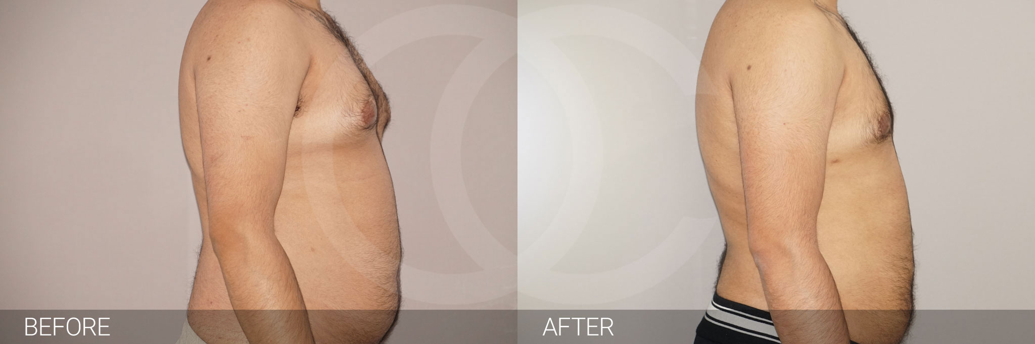 Antes y después Liposucción para hombres fotos reales de pacientes 3.2 | Ocean Clinic Marbella Madrid