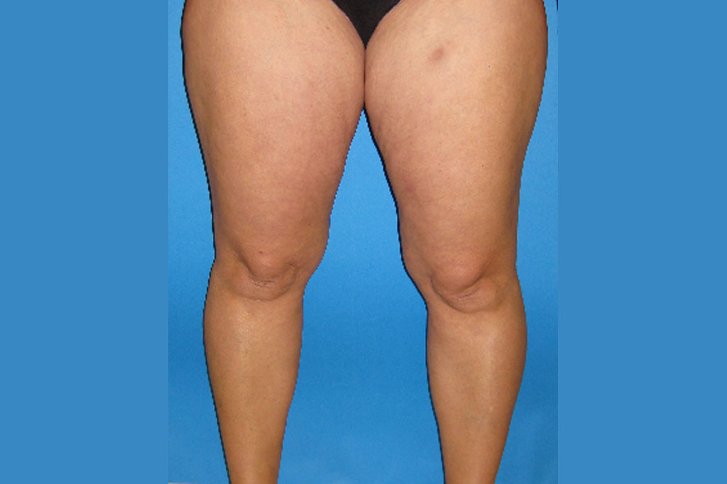 Liposuction Thighs ante/post-op I