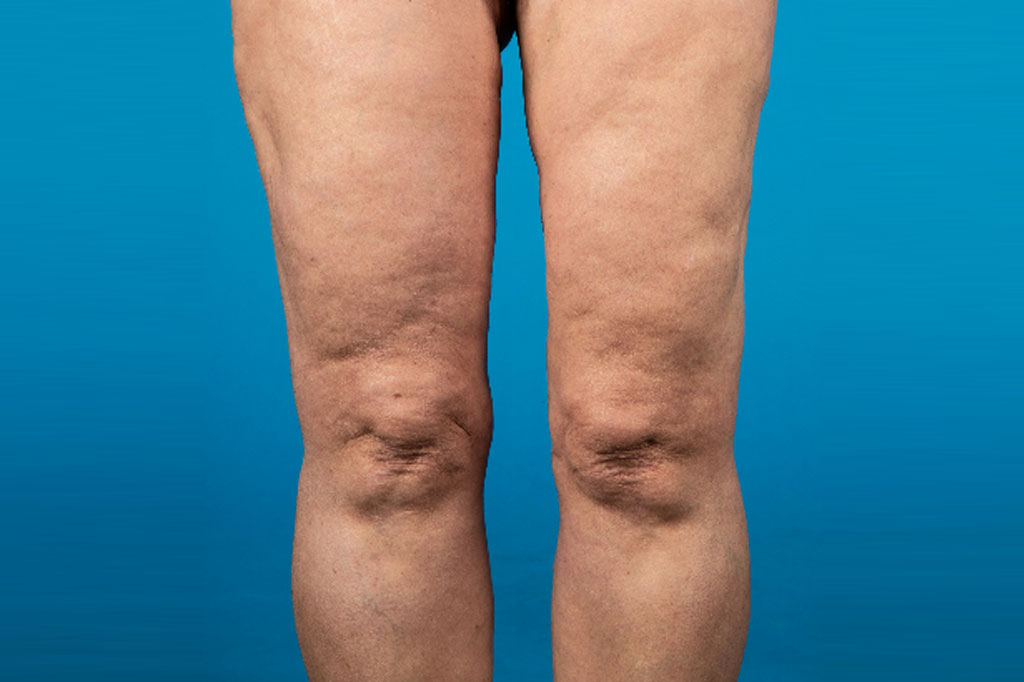 Liposuction Thighs ante/post-op I