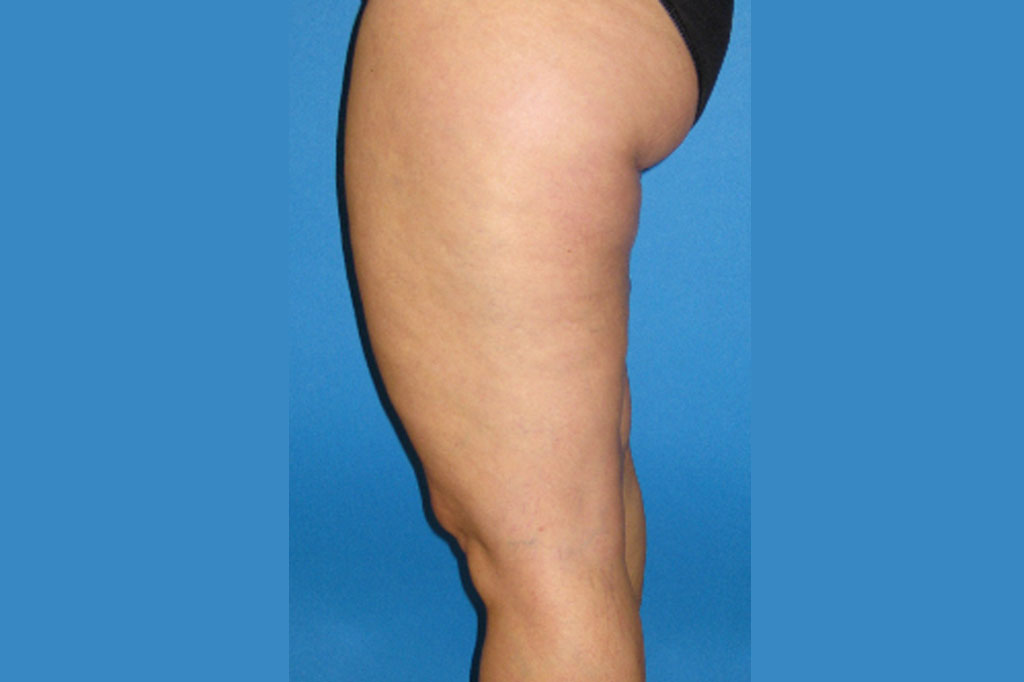 Liposuction Thighs ante/post-op II