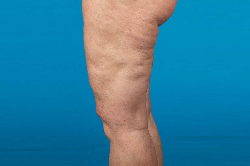 Liposuction Thighs ante/post-op II