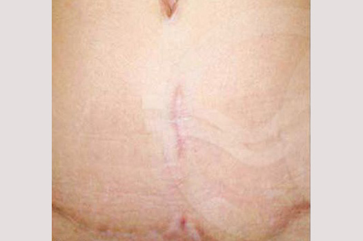 Corrección de cicatriz Cicatriz abdominoplastia ante/post-op I