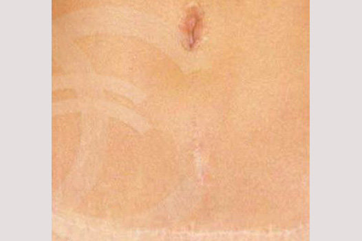 Corrección de cicatriz Cicatriz abdominoplastia post-op profil