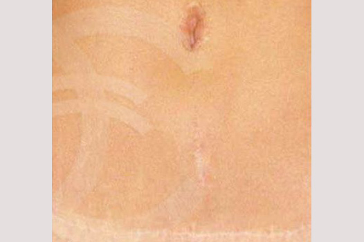 Scar Correction Abdominoplasty Scar ante/post-op I