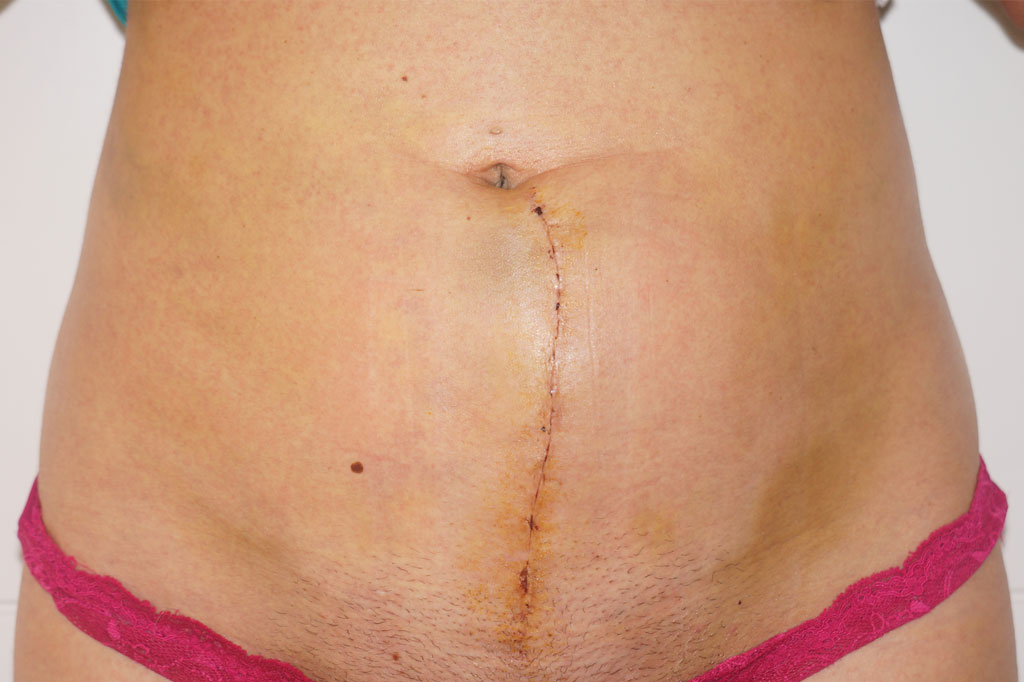 Scar Correction Hypertrophic scar ante/post-op I