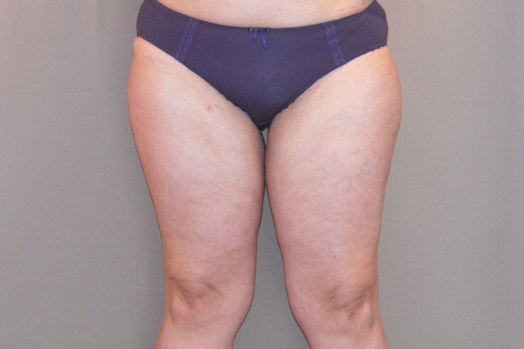 Thigh Lift Inner Thigh ante/post-op I