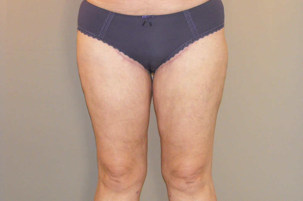 Thigh Lift Inner Thigh ante/post-op I