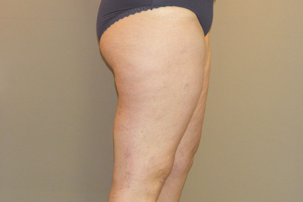 Thigh Lift Inner Thigh ante/post-op II