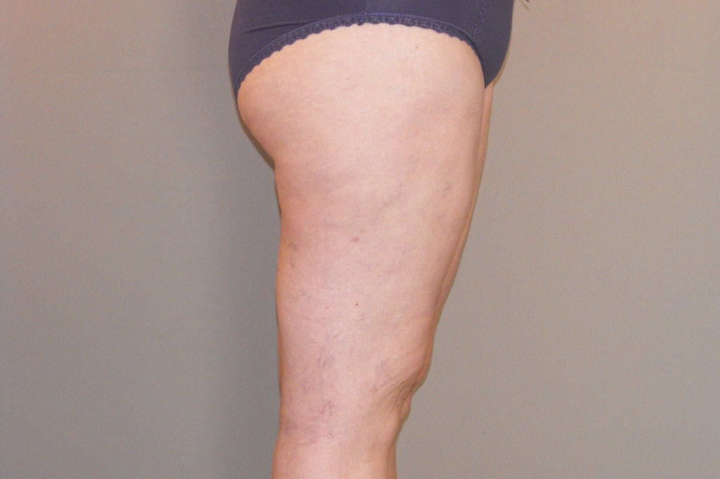 Thigh Lift Inner Thigh ante/post-op II