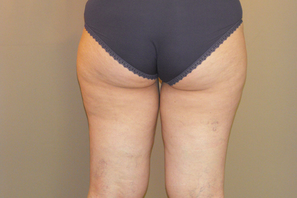 Lifting de muslos Liposucción Interna ante/post-op III