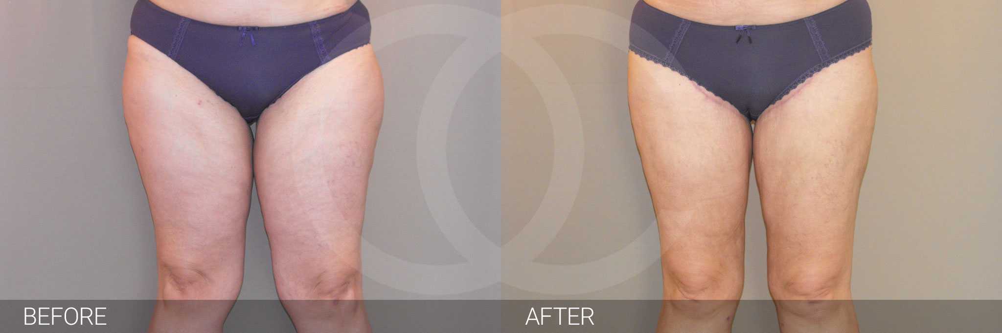 Thigh Lift Inner Thigh ante/post-op I