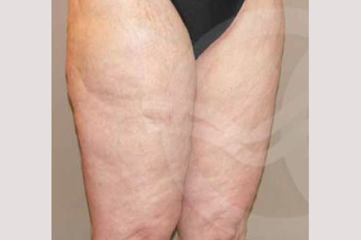 Thigh Lift Inner Crural Lift ante/post-op I