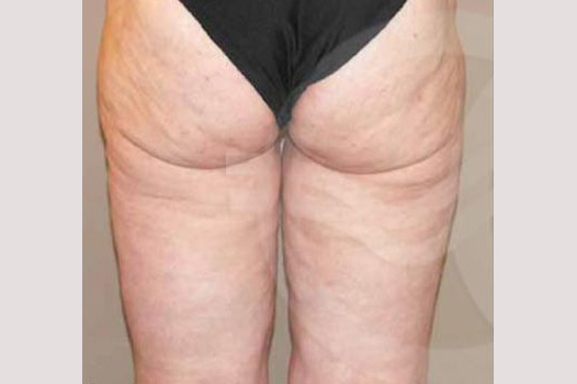 Thigh Lift Inner Crural Lift ante/post-op II