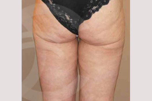 Thigh Lift Inner Crural Lift ante/post-op II